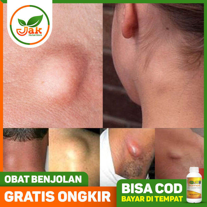 Obat Benjolan Di Leher / Benjolan Di Belakang Telinga / Benjolan Di
