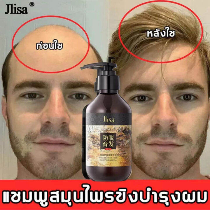 ZHENXIU 300ml แชมพูแก้ผมร่วง แชมพูขิง แชมพูสำหรับผมขาดหลุดร่วง ป้องกัน