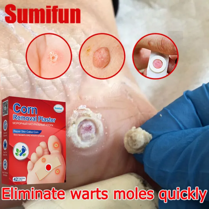 🚑 Sumifun The Corns Remove 42pcs Remove Cornscalluses Water Proof Corn Removal Patch Warts