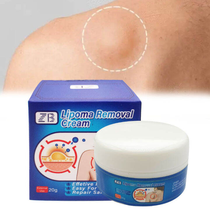 20g ZB Lipoma Removal Cream Treat Tumor Skin Swelling Ointment ...