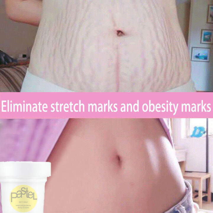 Pregnancy Cream Maternity Stretch Marks Ance Scar Remover Cream 100 Natural Ingredients/Krim
