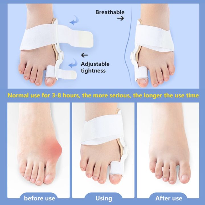 สายรัดนิ้วเท้า-อุปกรณ์ประคองนิ้วเท้า-เฝือกจัดกระดูกเท้า-แก้ปัญหานิ้วหัวแม่เท้าเก-hallux-valgus