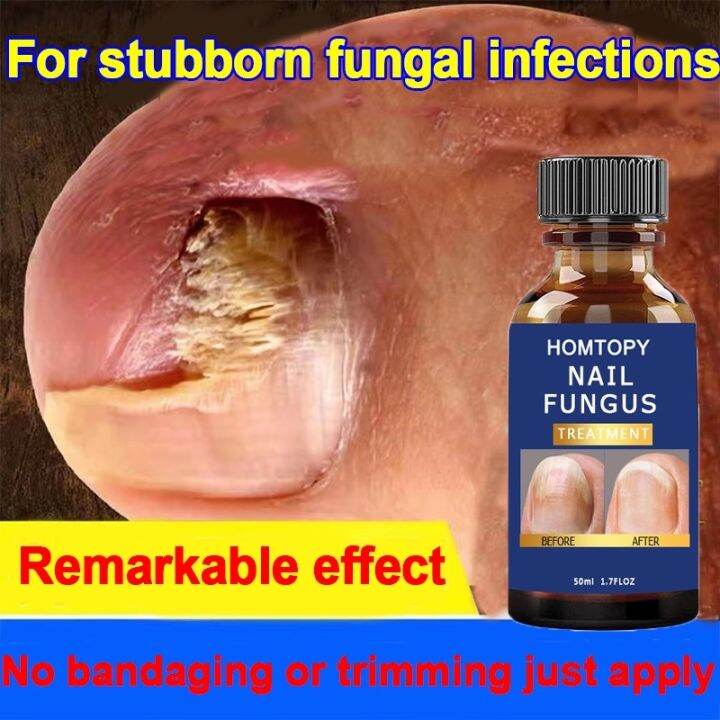 Nail fungus repair treatment Cream 50ml Fungisol Antifungal Cream Nail
