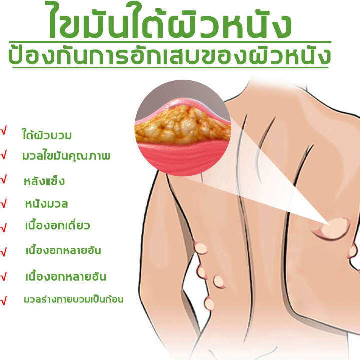 lipoma-removal-cream-ครีมก้อนเนื้องอกไขมัน-ครีมทาเนื้องอกไขมันกำจัดปัญหาใต้ผิวหนัง-ก้อนไขมันแข็ง-เนื้องอกไขมัน-สมุนไพรกำจัด-ก้อนเนื้อใต้ผ