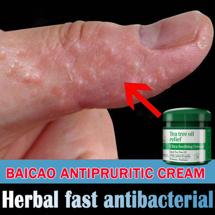 Herbal Antibacterial Ointment Antiitch Mosquitoantib Herbal Medicine