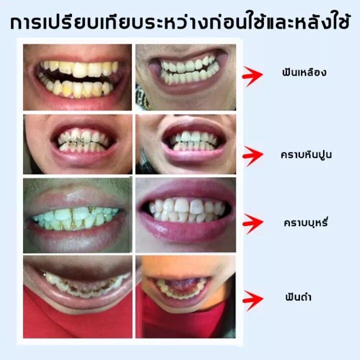 vrsti-เจลฟอกฟันขาว-ปากกาฟันขาว-ขัดฟันขาว-แก้ฟันเหลือง-ฟอกฟันขาว-คราบกาแฟ-คราบฟัน-ขจัดคราบหินปูน-ปากเหม็น-เหมาะสำหรับทุกคน-ยาฟอกฟันขาว-ปากกาฟอกฟันขาว-น้ำยาฟอกสีฟัน-เจลฟอกสีฟัน-เซรั่มฟอกฟันขาว-ปากาฟอกสี