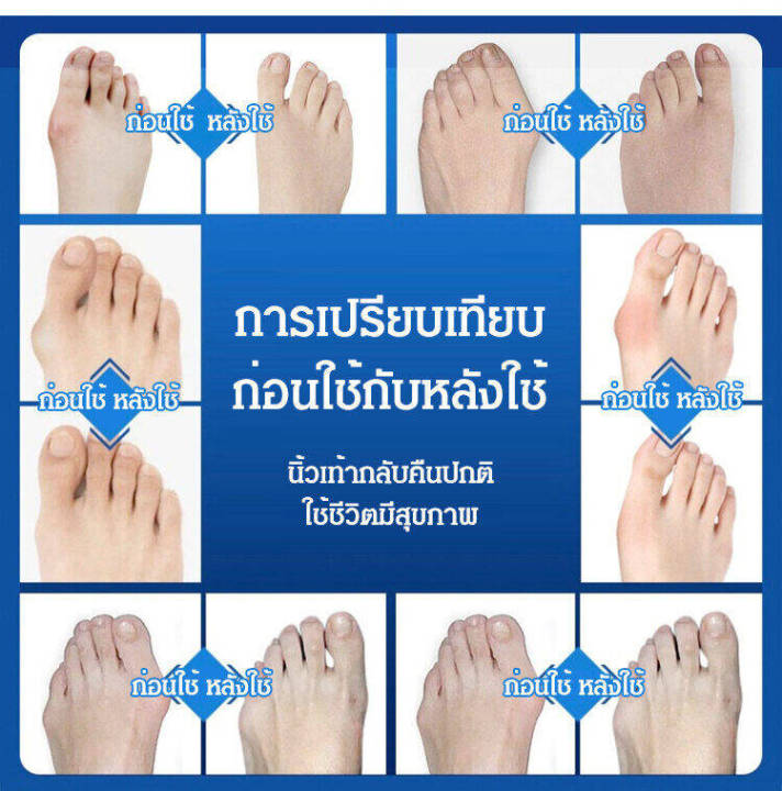 นำเข้าจากประเทศเยอรมนี-อุปกรณ์ดัดนิ้วเท้า-อุปกรณ์แก้ไขเท้าผิดรูป-ซิลิโคนคั่นนิ้วเท้า-อุปกรณ์คั่นนิ้วเท้า-อุปกรณ์แก้ไขเท้า-นิ้วโป้งโค้งงอเข้