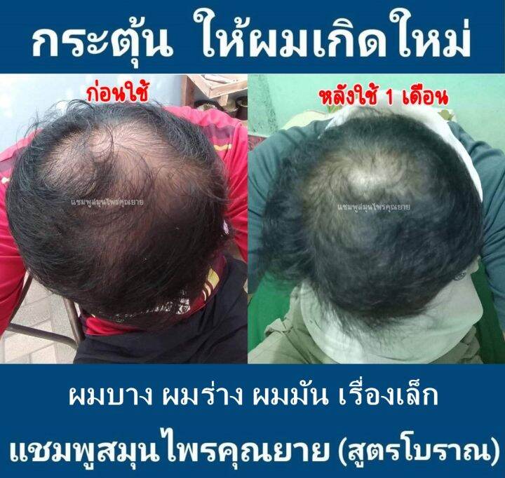 แชมพูสูตรสมุนไพรสร้างผมเกิดใหม่-ลดผมหลุดร่วง-ผมบาง-หัวล้าน-แชมพูสมุนไพร-17-ชนิด