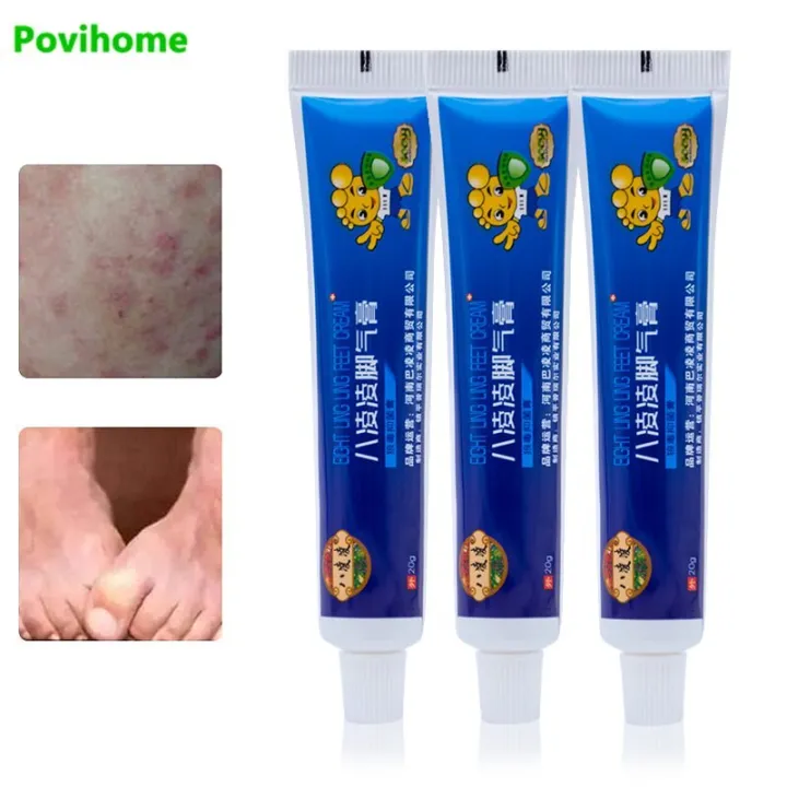 1pcs Itchy Feet Athlete's Foot Cream Anti Fungal Infections Foot Cream ...