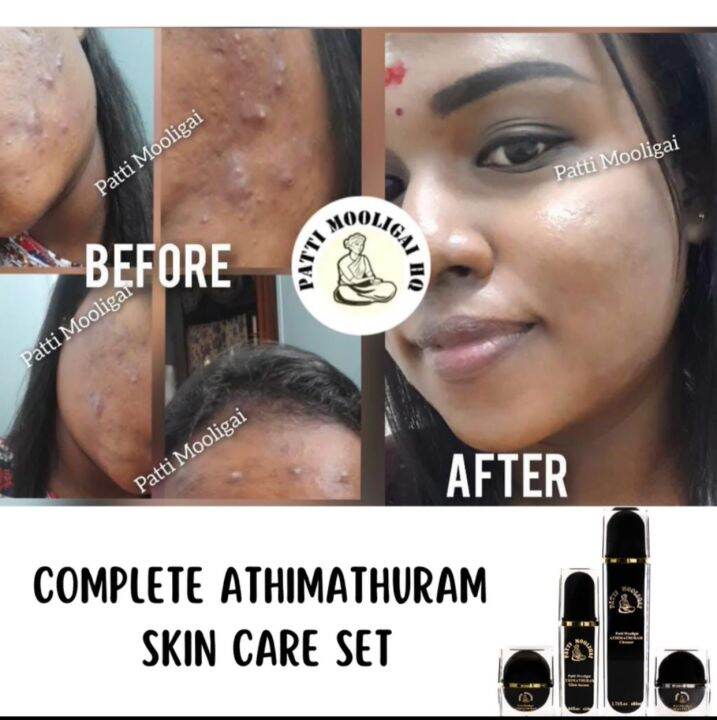 Complete Athimathuram Skin Care Set Lazada