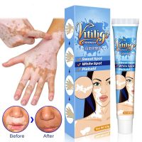 20G Herbal Extract Vitiligo Ointment Remove Ringworm White Spot Removal Skin White Spot Leukoplakia Disease Treatment Cream