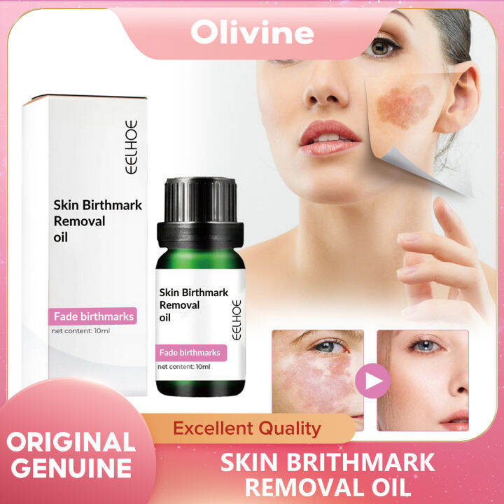 EELHOE Skin Birthmark Removal Oil Original Lighten Spots Essential Oils ...