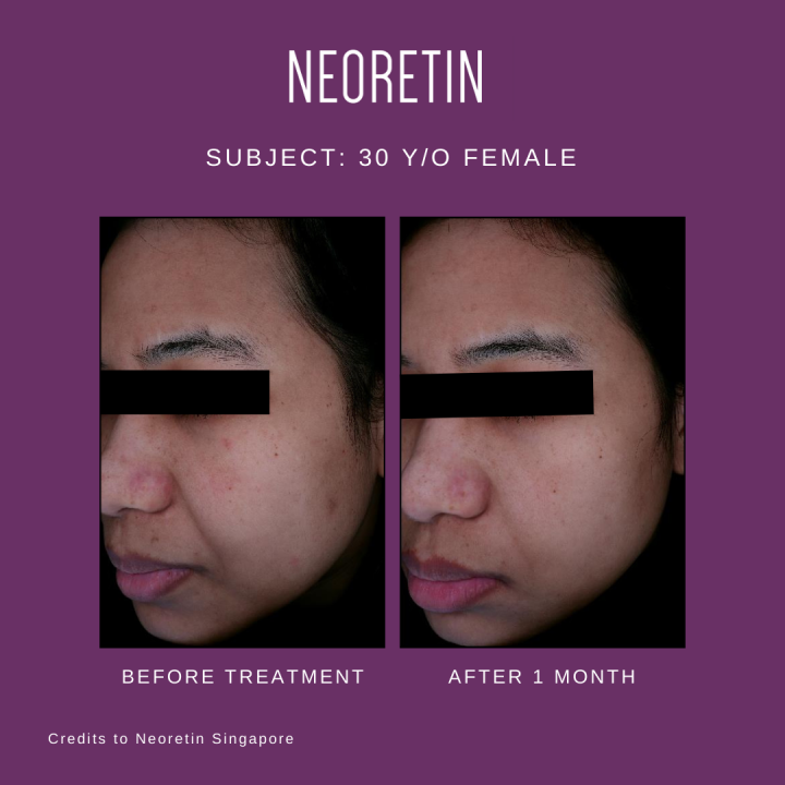 มีของแถม-neoretin-serum-30ml-neoretin-gel-cream-spf50-40ml-เวชสำอาง-nbsp-จุดด่างดำ-ผิวหมองคล้ำ-สีผิวไม่สม่ำเสมอ-ครีมทาฝ้า-ปรับสีผิว