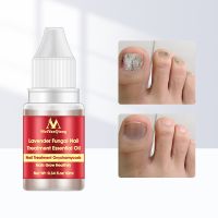 Fungal Nail Treatment Serum Onychomycosis Paronychia Anti Fungal Nail Infection Herbal Toe Fungus Foot Repair Essence Care 10ml