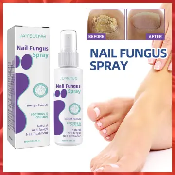 Discover 142+ fungal nail infection spray best - ceg.edu.vn