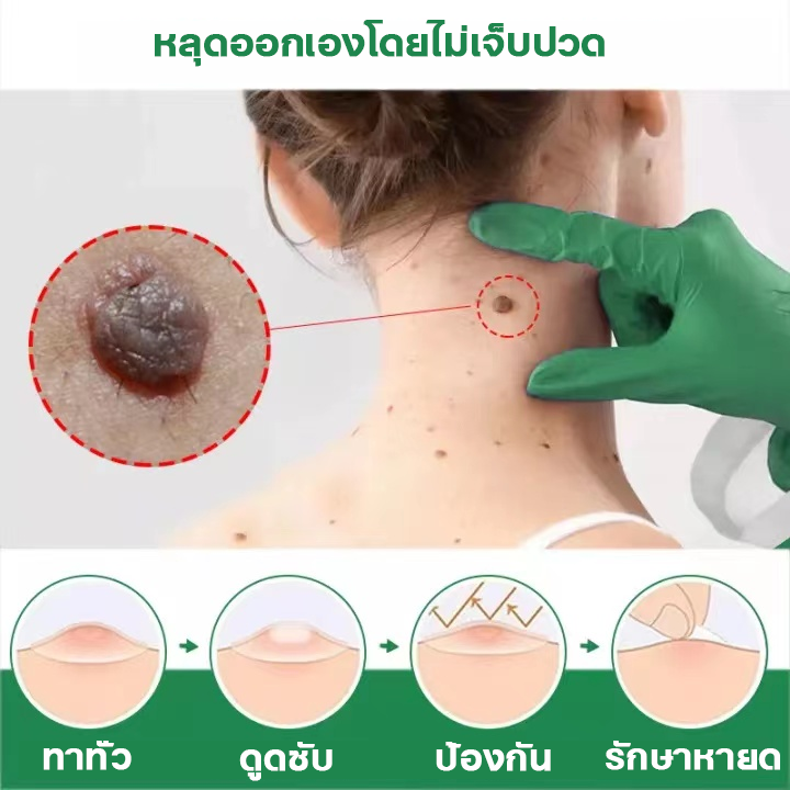 ขี้แมลงวัน-หูดตาปลาและติ่งเนื้อ-ของแท้-corns-warts-removal-พร้อมส่ง-ไฝ-ไฝ-แต้ม-ทาไฝ-ทาขี้แมลงวัน-ไพลิน