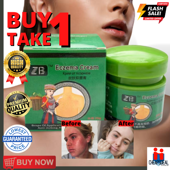 [BEST SELLER ) B1T1 ZB ECZEMA CREAM 20g | 100% ORIGINAL , AUTHENTIC And ...