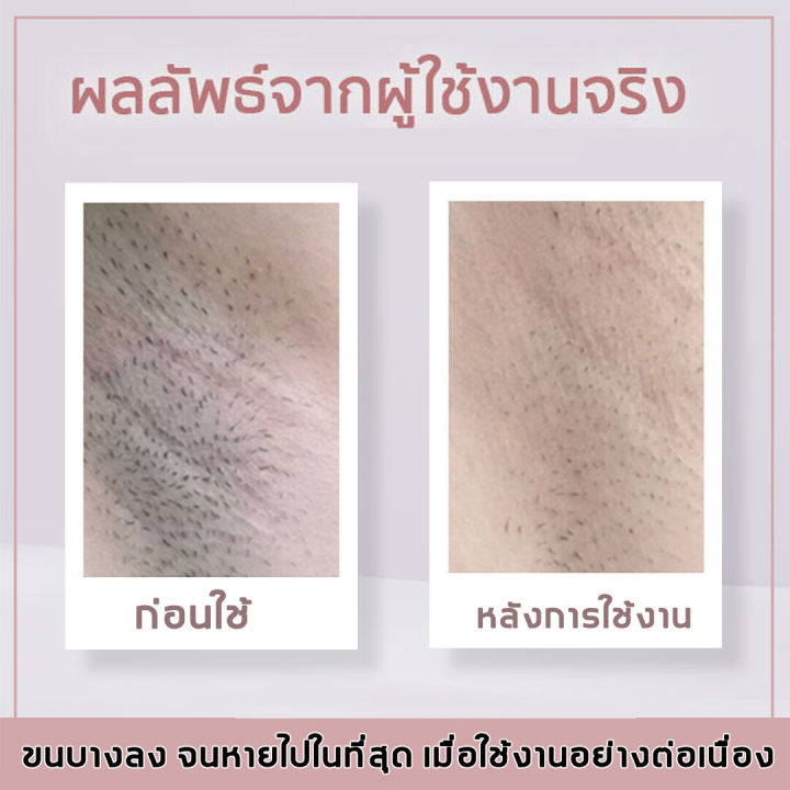 ไม่มีจุดด่างดำ-เครื่องกำจัดขนสตรี-5-in-1-ถอนขนไม่เจ็บ-ไม่ทิ้งตอ-ใช้ได้ทั้งตัว-เครื่องกำจัดขน-เครื่องโกนหมอย-เครื่องถอนขน-ที่โกนขนที่ลับ-กำจัดขนถาวร-เครื่องโกนขน-ที่โกนขน-เครืีองกำจัดขน-กำจัดขนไฟฟ้า-ที