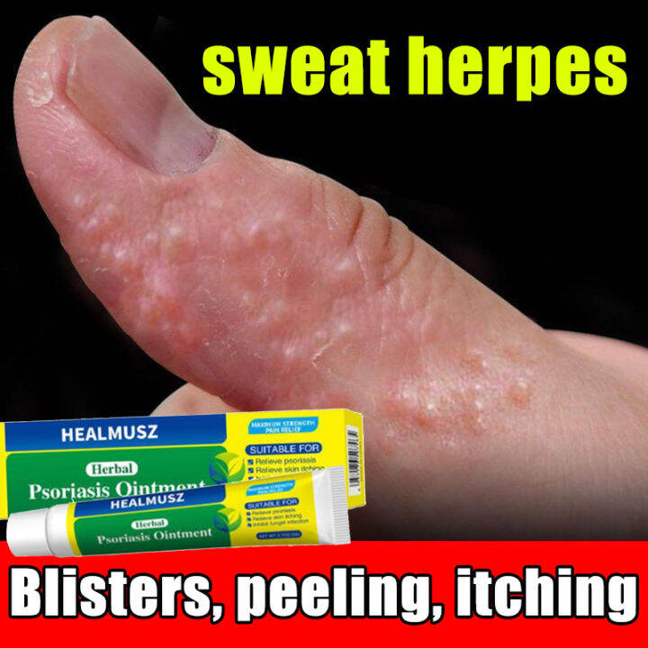 3 Seconds To Relieve Itching Sweat Herpes Treatment Antibacterial Cream