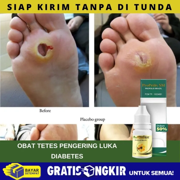 Obat Herbal Pengering Luka Diabetes Basah, Obat Luka Borok Di Kaki