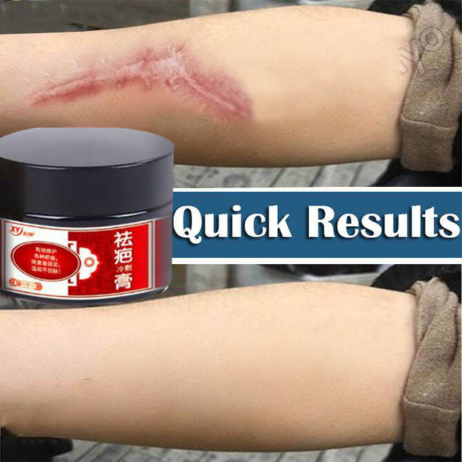Scar removal cream to scar repair facial bump scar paste medical