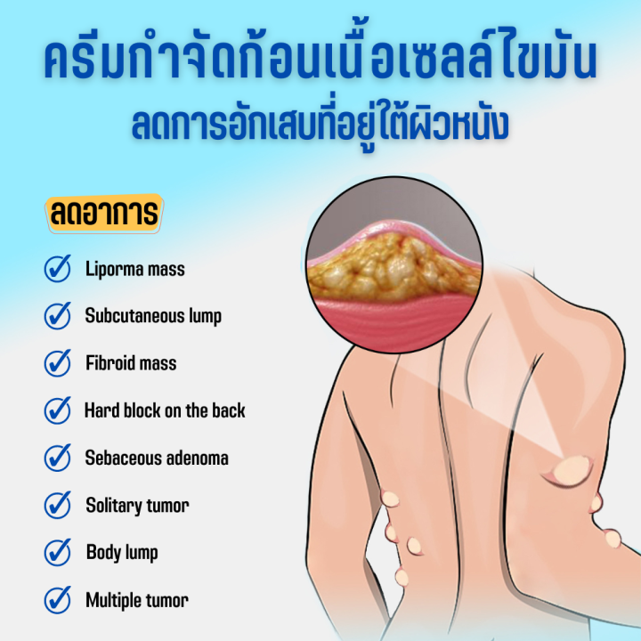 บรรเทาปูนปลาสเตอร์ผิวบวมครีมก้อนใต้ผิวหนัง-สารสกัดจากพืชธรรมชาติ-lipoma-treatment-balm-กำจัดเนื้องอกผิวหนังบวม-ทาแก้ปวด-บำรุงผิวกายเซลลูไลท์