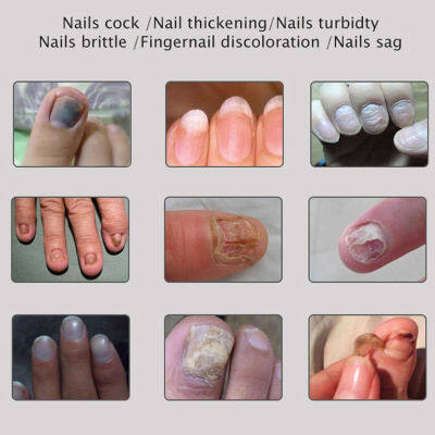 BELLE 1ชิ้นป้องกันเชื้อราเล็บรักษาครีม Onychomycosis NAIL infection Feet Care