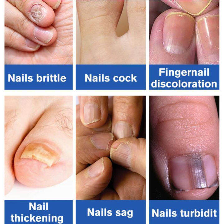 Nail Fungal Treatment Feet Care Essence Anti Infection Paronychia Onychomycosis Nail Foot Toe