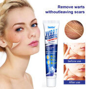 20g mụn cóc Remover kem da nevus Kem tẩy cho phụ nữ người đàn ông corns