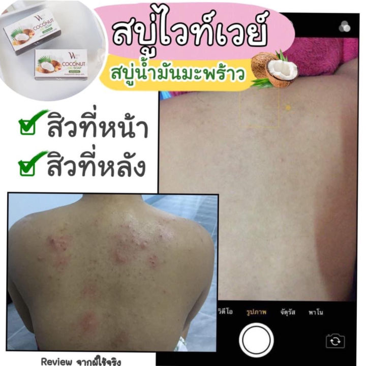 สบู่ไวท์เวย์-whiteway-แท้ราคาส่ง-สบู่น้ำมันมะพร้าว-สบู่ลดสิว-สิวที่หน้า-สิวที่หลัง