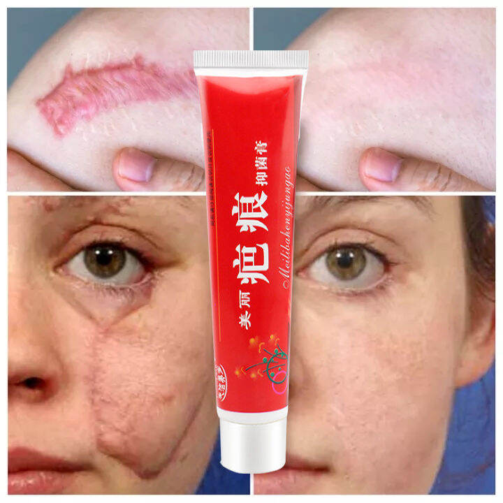 Scar gel remover scar remover cream scar remover for old scar on leg ...