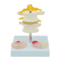 Anatomical Lumbar Spine Model แสดง4th Lumbar Vertebra 5th Lumbar Vertebra Personal Lumbar Disc Normal Disc Nerve