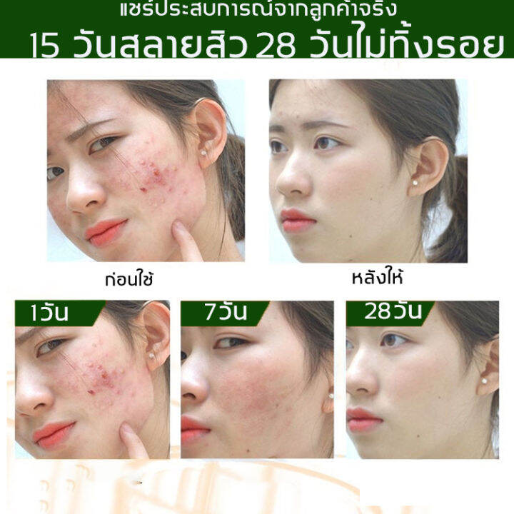 breylee-เซรั่มลดสิว17ml-เซรั่มรักษาสิว-สามารถลดสิว-บล็อกสิว-สิวไม่อักเสบ-สิวหัวขาว-สิวหัวดำ-กำจัดสิว-สิวอุดตัน-สิวผด-ไม่มีหัว-หลุมสิว-ซ่อน-ลดรอยแผลเป็นจากสิว-รอยดำจากสิว-ครีมแต้มสิว-เจลรักษาสิว-ครีมกำ