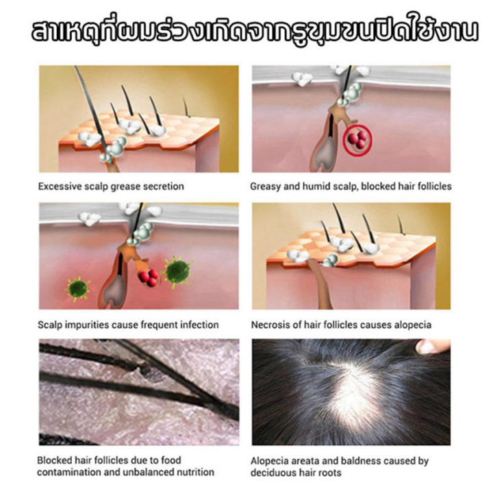 บอกลาหัวล้านlansiyi-น้ำยาปลูกผม-แก้ปัญหาผมร่วง-สเปรย์ปลูกผม-ป้องกันผมร่วง-สเปรย์ปปลูกผม-เซลั้มปลูกผม-เซรั่มปลูกผม-เร่งผมยาวไว-ปลูกผมเร่งด่วน-ยาปลูกผมของแท้-น้ำยาเร่งผมยาว-ครีมปลูกผม-เซรั่มเร่งผมยาว-เซ