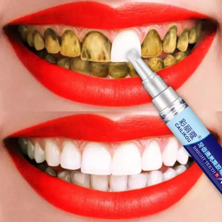 Teeth Whitening Pen Remove Stains And Yellow Teeth Teeth Cleaning For