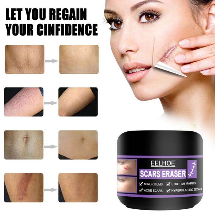 50g Original Scar Remover Peklat Remover Cream Original Acne Scar