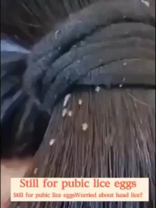 Head lice aliz remover shampoo for kids removal licealiz eggs for kids