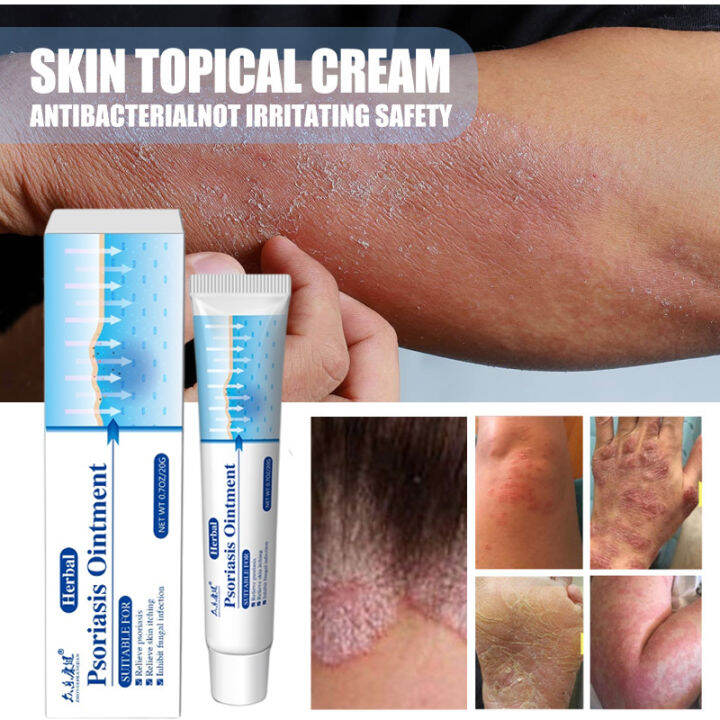 HOT SALE】Antibacterial Psoriasis Cream Herbal Treatment Eczema Relief ...