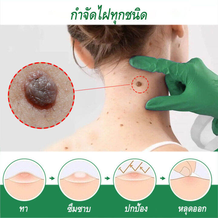 wart-removal-liquid-เอสเซ้นลอกหูด-10ml-ยาแต้มหูด-ลอกหูดตาปลา-ปลอดภัยไม่เจ็บตัว-ขจัดติ่งเนื้อ-เอสเซ้นลอกหูด-ไม่ทิ้งร่องรอยป-ครีมกําจัดไฝหูดติ่งเนื้อ