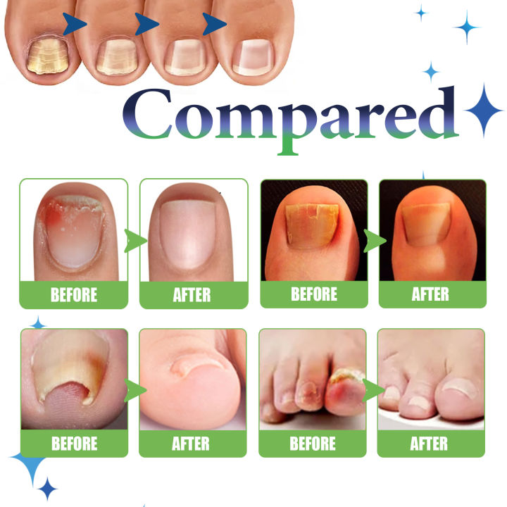 ouhoe-เจลกำจัดเชื้อราเล็บเท้าการรักษาเล็บเชื้อราแบบเหลวป้องกันการติดเชื้อ-onychomycosis-เท้าเล็บเท้ากำจัดเชื้อราเจลบำรุงผิวซ่อมแซมปัญหาเล็บ-75มล-ถุง