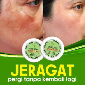 Shop Ubat Sakit Kulit Kurap Online Jun 2022 Lazada Com My