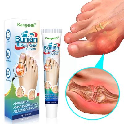 【CW】 1pcs Bunion Treatment Ointment Toe Joint Pain Gout Stiffness 20g Treat Arching Limb Anti-infl G3q1