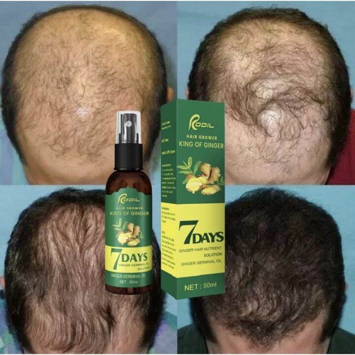 Rodil Hair Grower King of Ginger Hair grower Ginger Hair grower Lazada PH