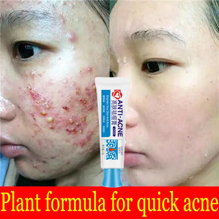 Acne Removal Cream 25g Plant Acne Removal Cream Cleansing and soothing