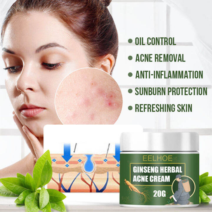 Ginseng Herbal Acne Cream Pimple Remover Acne Marks Remover Skin Care