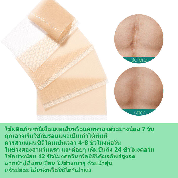 มีcod-แผ่นแปะแผลเป็น-4pcs-ซ่อมแซมรอยแตกลาย-แผลผ่าตัด-แผลผ่าตัดหลังคลอด-สติกเกอร์ความงาม