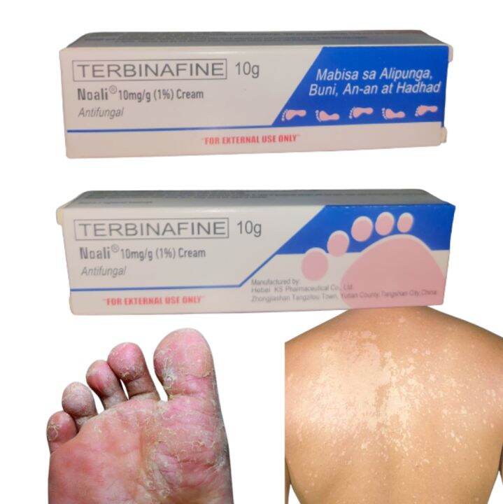 Terbinafine Antifungal Cream Effective for Buni, Anan, Hadhad and