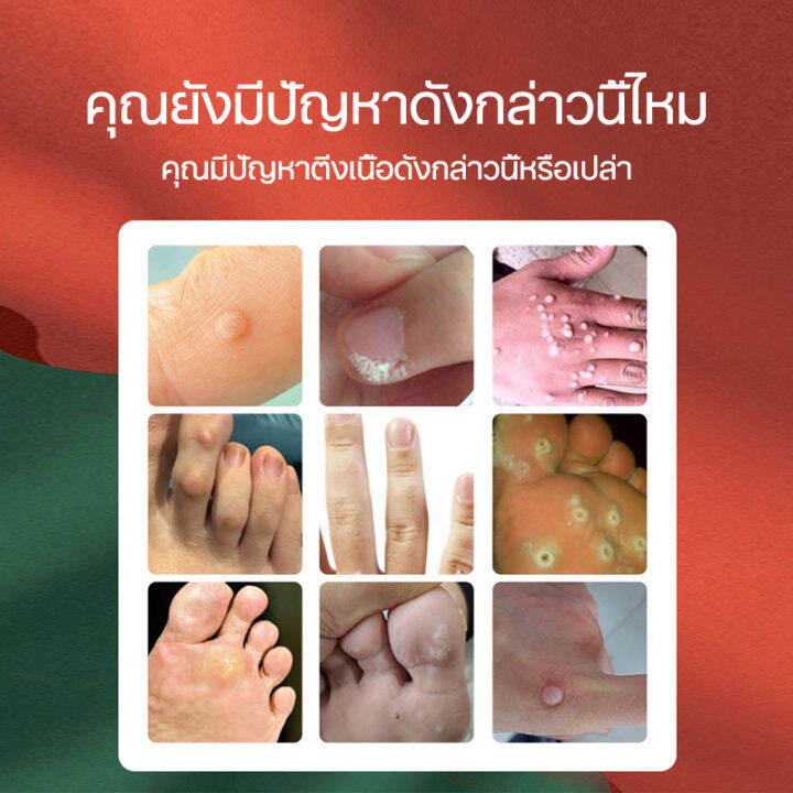 wart-removal-liquid-เอสเซ้นลอกหูด-10ml-ยาแต้มหูด-ลอกหูดตาปลา-ปลอดภัยไม่เจ็บตัว-ขจัดติ่งเนื้อ-เอสเซ้นลอกหูด-ไม่ทิ้งร่องรอยป-ครีมกําจัดไฝหูดติ่งเนื้อ