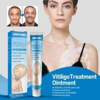 ส่งฟรี Vitiligo ครีมรักษาโรคมาลานิน รักษาแบคทีเรีย จุดด่างดํา 20 กรัม