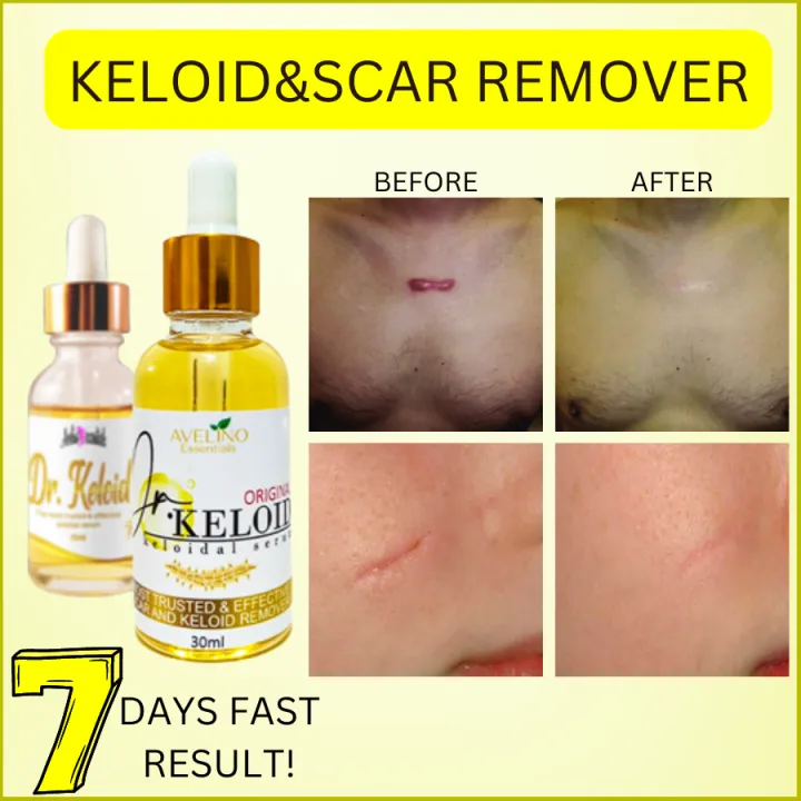 MIRACLE DR. KELOID / Keloid Scar remover original / keloid remover